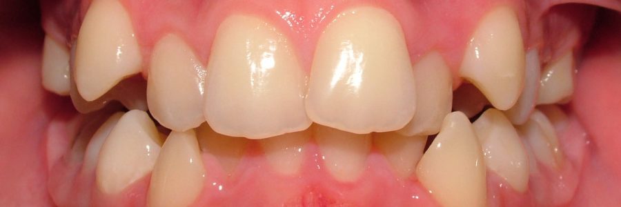 Caso Ortodoncia con extracciones