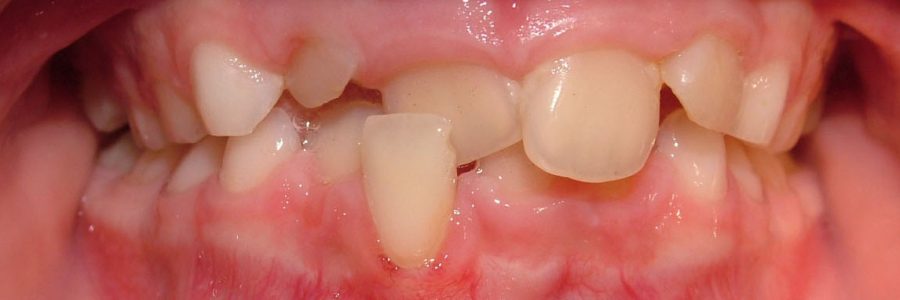 Caso Ortodoncia Interceptiva primera fase