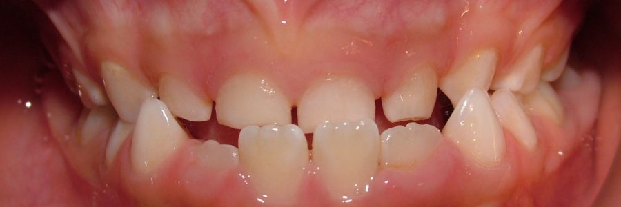 Caso Ortodoncia Interceptiva en dentición mixta primera fase