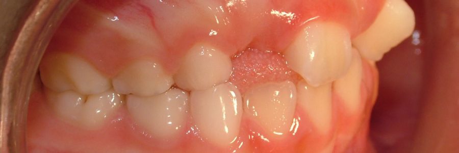 Caso Ortodoncia Interceptiva primera fase