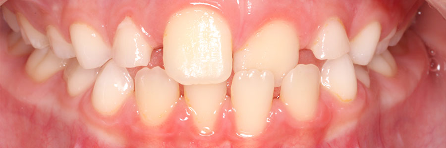 Caso inversión oclusal incisivo superior izquierdo