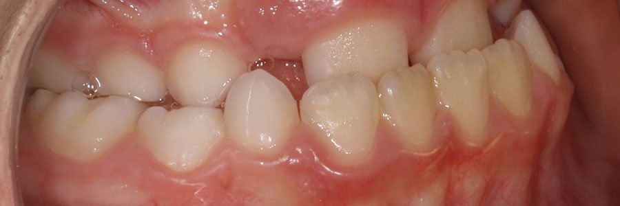 Paciente clase III con mordida invertida